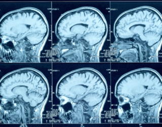 1787609400-creutzfeldt-jakob-e-uma-condicao-neurologica-rara-que-provoca-degeneracao-progressiva-do-cerebro-3389328-article